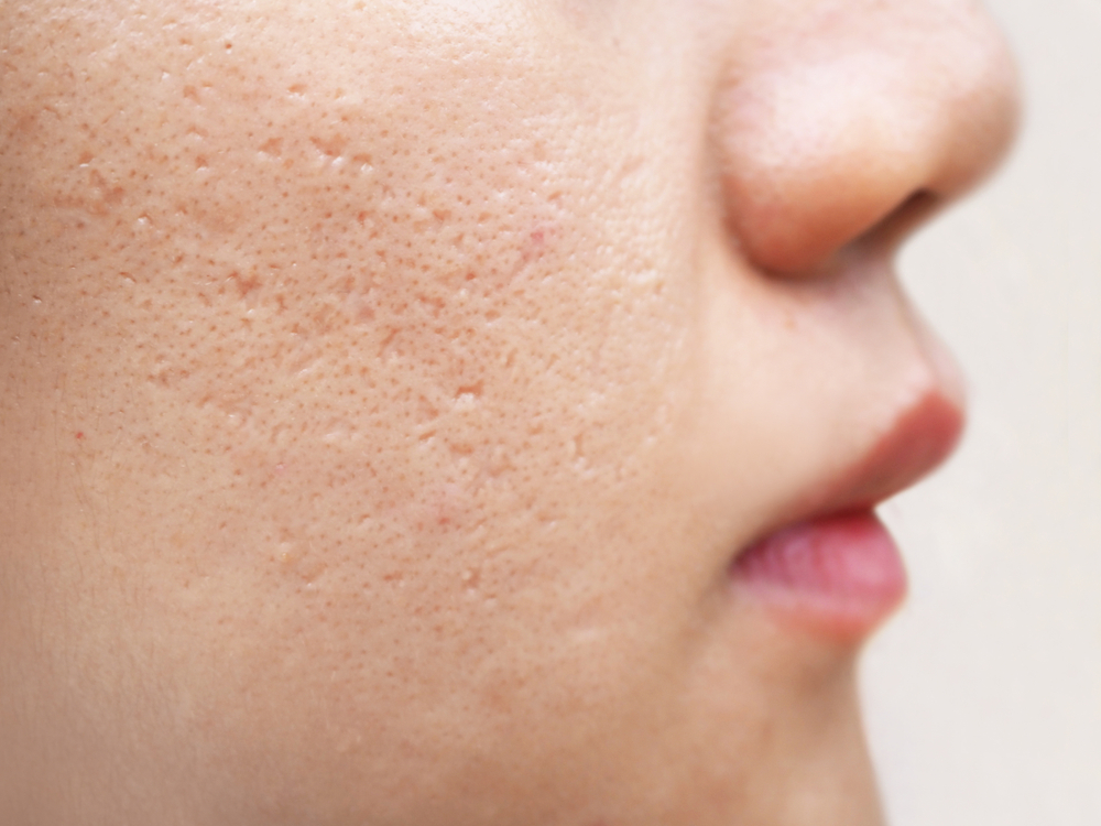acne scars on cheek